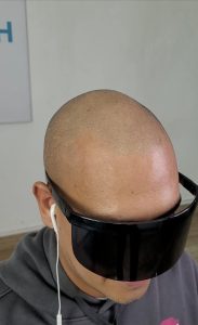 efecto cabello rapado