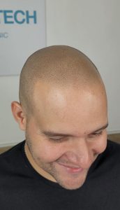 micropigmentación