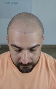 micropigmentación capilar
