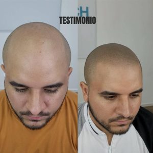 micropigmentación capilar en hombres