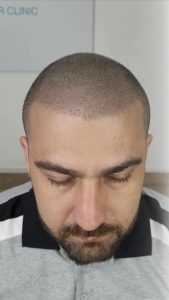 micropigmentación capilar hombres