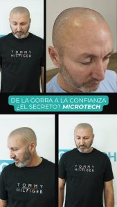 micropigmentación capilar mujeres