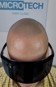 pigmentación cuero cabelludo hombre
