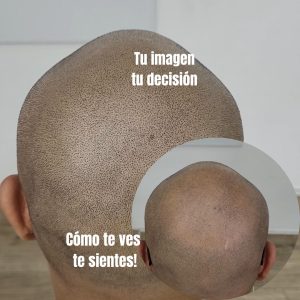 resultados de micropigmentación capilar
