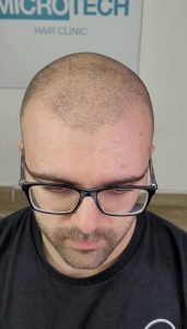 resultados naturales micropigmentación
