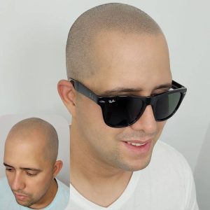 técnica pelo a pelo capilar