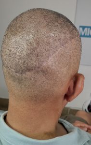 tratamiento capilar con micropigmentación