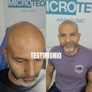 tratamiento para alopecia